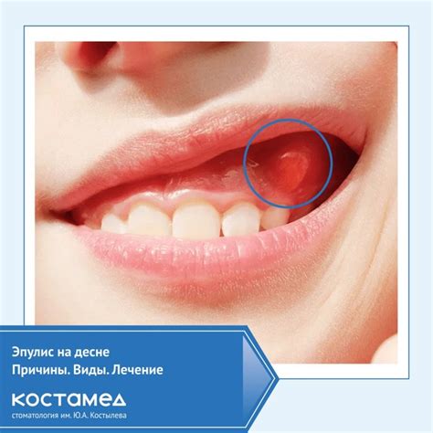 Today we will consider what is epulis, what factors provoke its ...