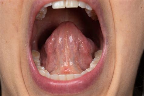 Подрезание уздечки языка | stomatclinica.com.ua