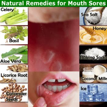 12 Natural Remedies for Mouth Sores that Work - NaturalRelieved