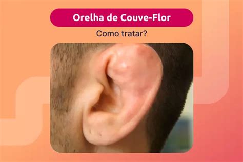 Como Estourar A Orelha - Estouro De Orelha 0g Piercings Na Cartilagem Feitos De Titânio