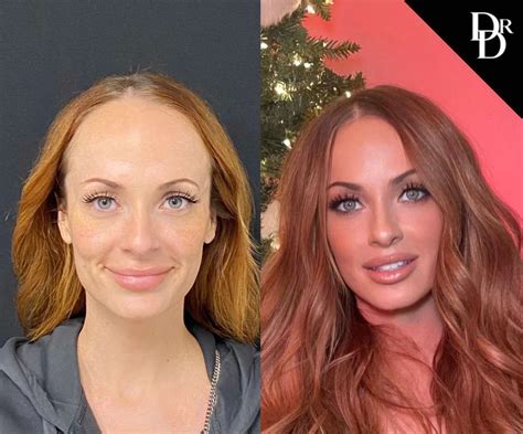 hairline lowering surgery  tampa fl dr demetri md