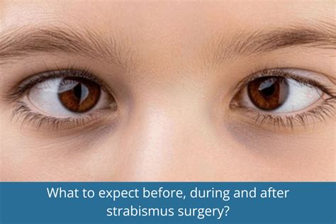 understanding strabismus  adults  diagnosis treatment
