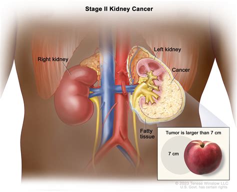 Transitional Cell Carcinoma Kidney