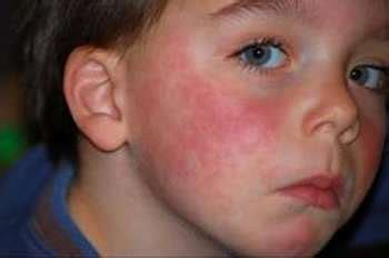 Allergie paraben | Medecine
