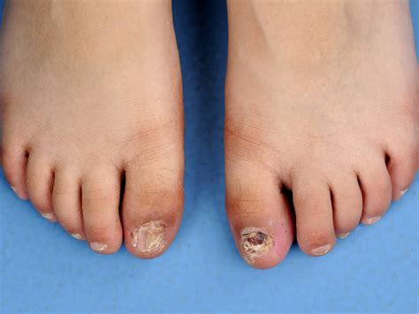 Erythrokeratodermia Figurata Variabilis