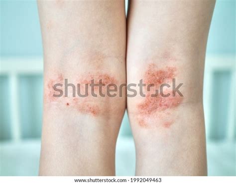 Eczema On Kids Legs Atopic Dermatitis Stock Photo 1992049463 | Shutterstock