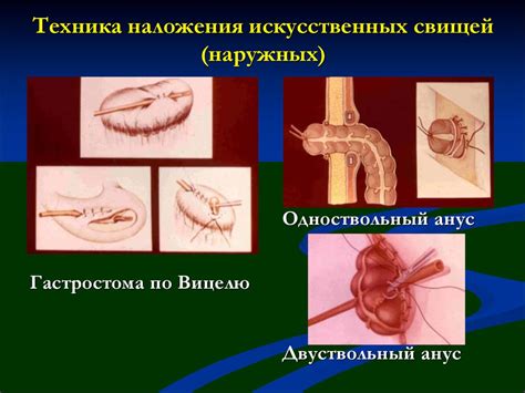 Свищи - презентация онлайн