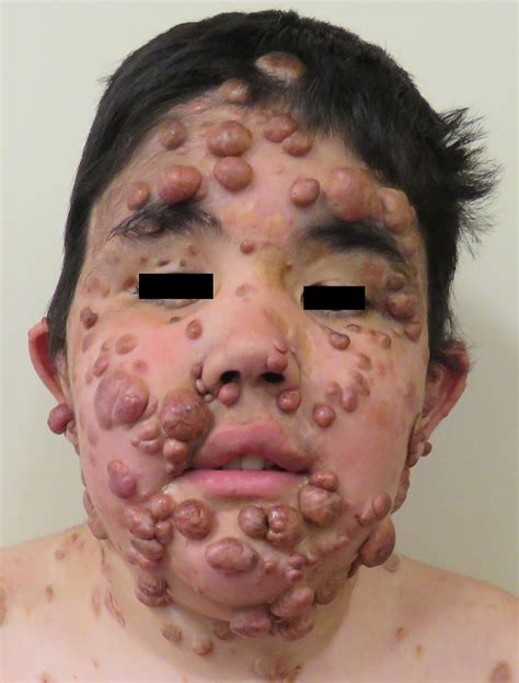 Progressive Nodular Histiocytosis