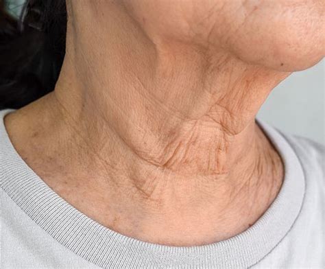 skin laxity conditions  clinic room theclinicroom