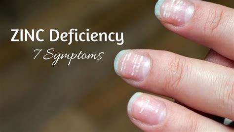 Zinc Deficiency Signs Symptoms Hair Loss, Acne, Infections), 49% OFF