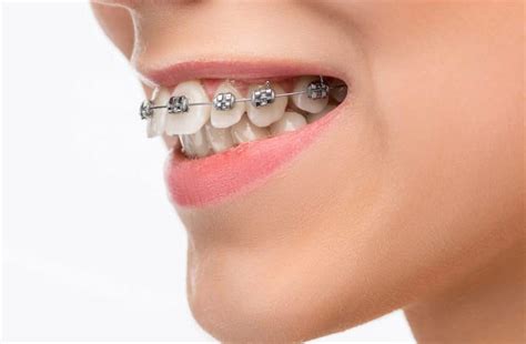 behel keramik  gigi berjejal  bogor klinik global estetik