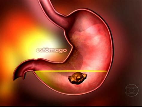 Vídeo: Gastrite é uma inflamação da parede do estômago | RJ1 | G1