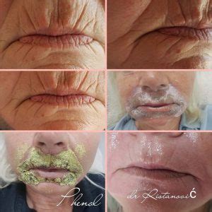 All About Phenol Peel: Is It Worth It? Risks & Results