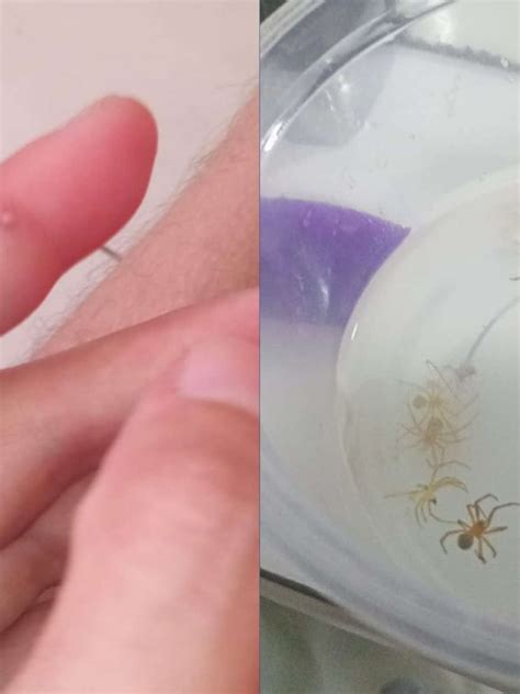 Fotos De Picadas De Aranha - 10