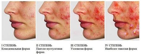 Эпидермальный стафилококк защитит от прыщей