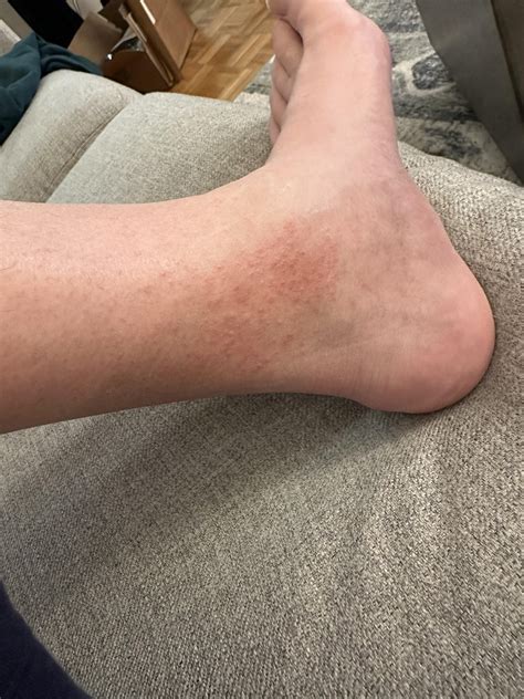 Itchy raised rash on ankle : r/DermatologyQuestions