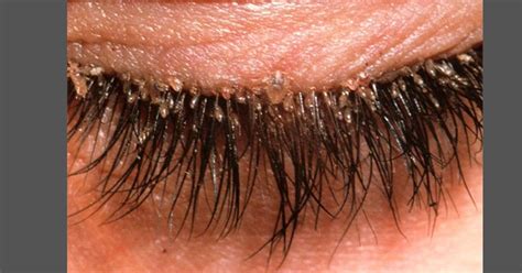 O que é Demodex folliculorum e o que você deve saber - Sou Enfermagem