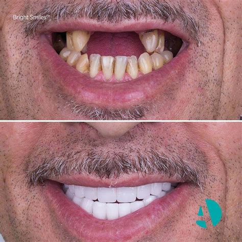Dental Implants in Turkey, Save up to 70% | Antlara Antalya