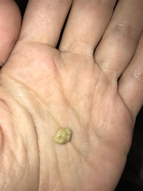 738 best Tonsil Stones images on Pholder | Tonsilstones