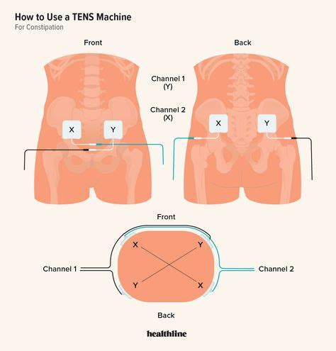 TENS Placement for Constipation: Instructions and FAQs Constipation ...