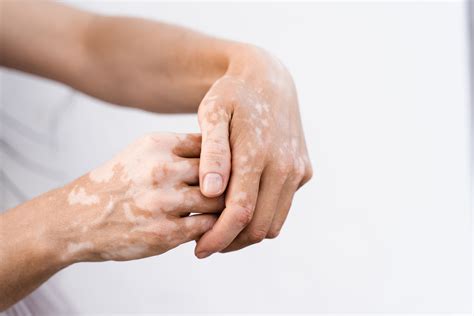 UVB Phototherapy and Tofacitinib Are Effective for Combined Vitiligo