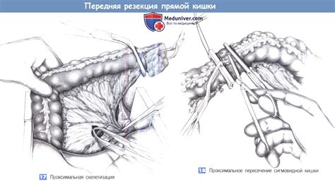 Показания, этапы, техника передней резекции прямой кишки