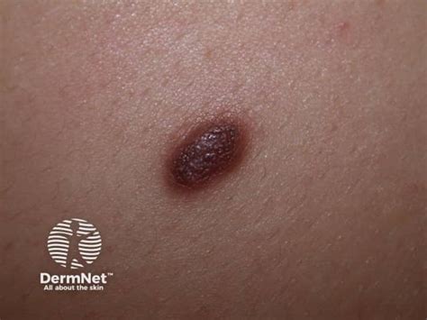 Dermatofibroma Images
