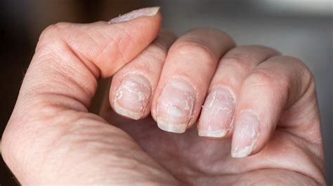 What causes brittle nails? - Reviewed