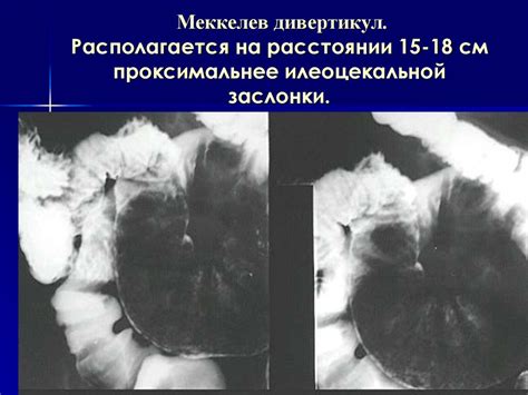 Рентгеносемиотика заболеваний ЖКТ - презентация онлайн