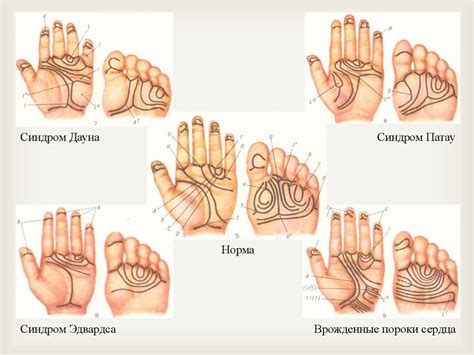 Дерматоглифика как метод генетического исследования человека ...