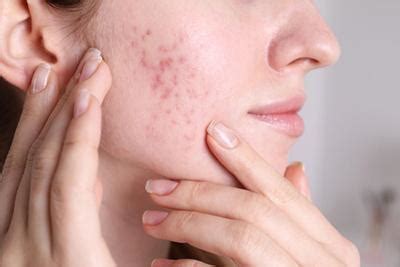 Combating Adult Acne