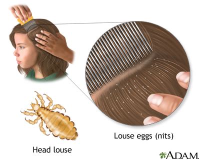 Human Lice Eggs