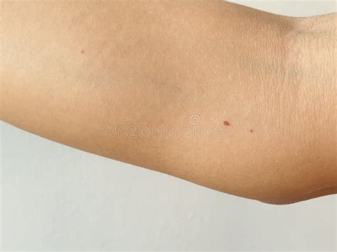 Angioma. Red Mole On The Skin. Bursting Vessel Capillary. Many Angiomas ...