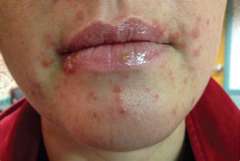 Syphilis Face Rash