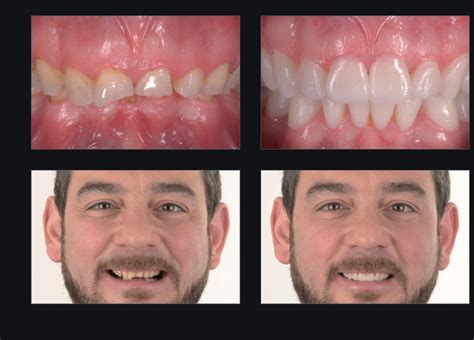 smile line filler recovery time