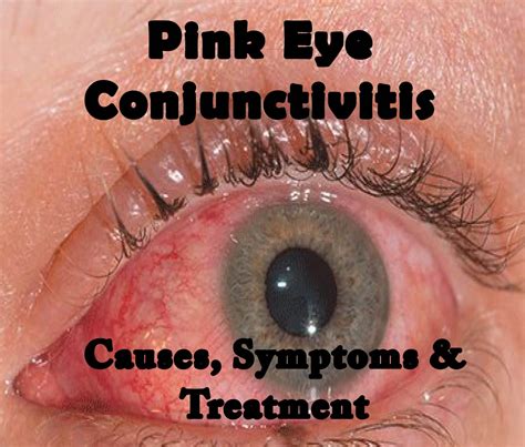 Understanding Pink Eye Conjunctivitis - Causes and Treatment