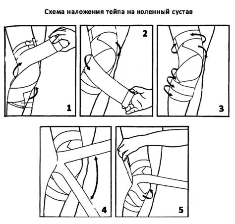 Тейпирование коленного сустава: что это, как работает, показания к ...