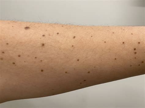 Moles — True Dermatology
