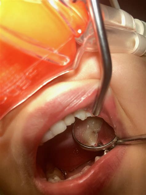 What Causes Cavities? Best Tips to Keep Your Teeth Healthy