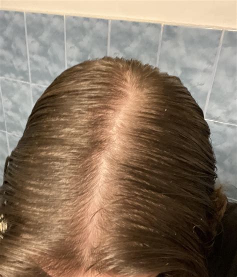 Naturally thin hair or just cope : r/malehairadvice