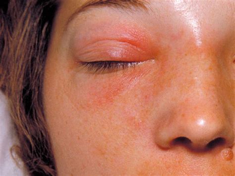 Cellulitis Cheek