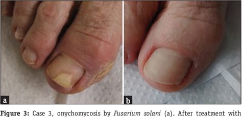 Figure 3 from Propolis for the Treatment of Onychomycosis | Semantic ...
