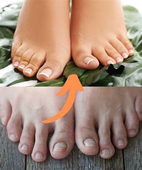 CultivateCraft - 5 Natural Remedies to Fight Nail Fungus 🍄 Nail fungus