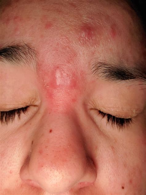 Huge Zit On Forehead Blind Pimples: How To Get Rid Of A Pimple Under