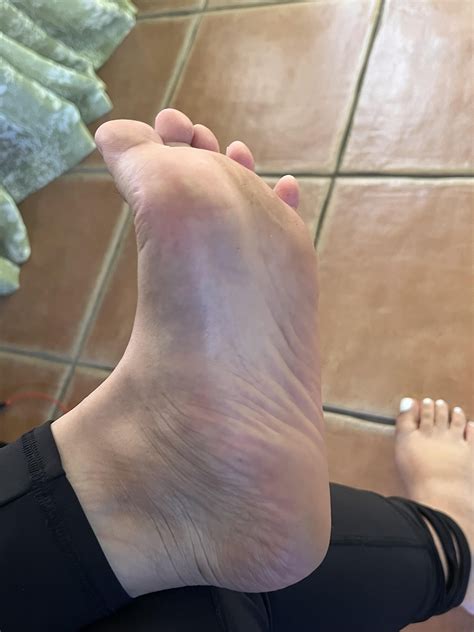 Does this look like atrophy (muscle loss) in my feet? I have had muscle
