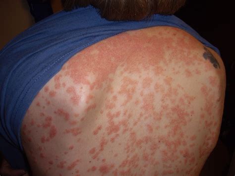 Guttate psoriasis - Alchetron, The Free Social Encyclopedia