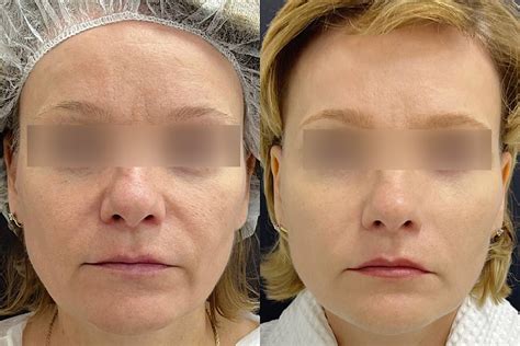 Нитевой лифтинг лица в Москве — VIP Clinic. Подтяжка лица без операции ...