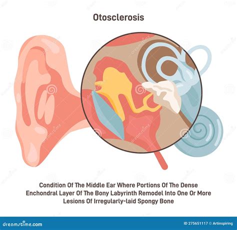 Otosclerosis. Medical Condition of the Middle Ear Bones Inside Stock