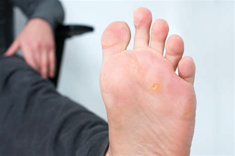 How to remove and avoid foot corns | Union Santé