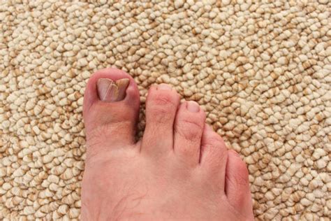 Curved Toenails Stock Photos, Pictures & Royalty-Free Images - iStock